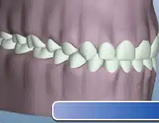 crown-lengthening-animation